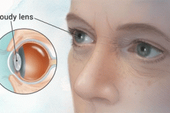 Cataract leading cause of blindness in Taraba – Ophthalmologist