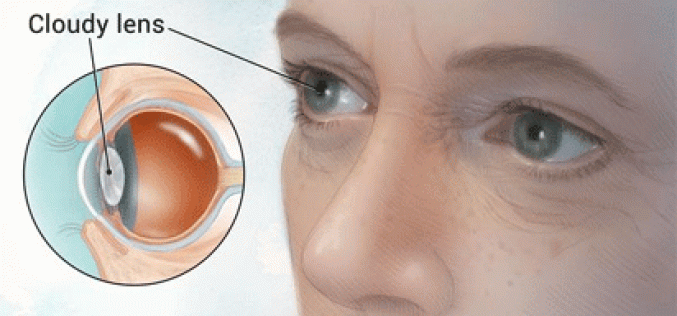 Cataract leading cause of blindness in Taraba – Ophthalmologist