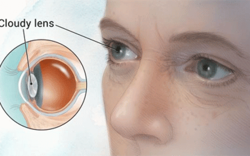 Cataract leading cause of blindness in Taraba – Ophthalmologist