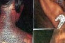 Senate Directive: Dermatologist cautions against skin bleaching