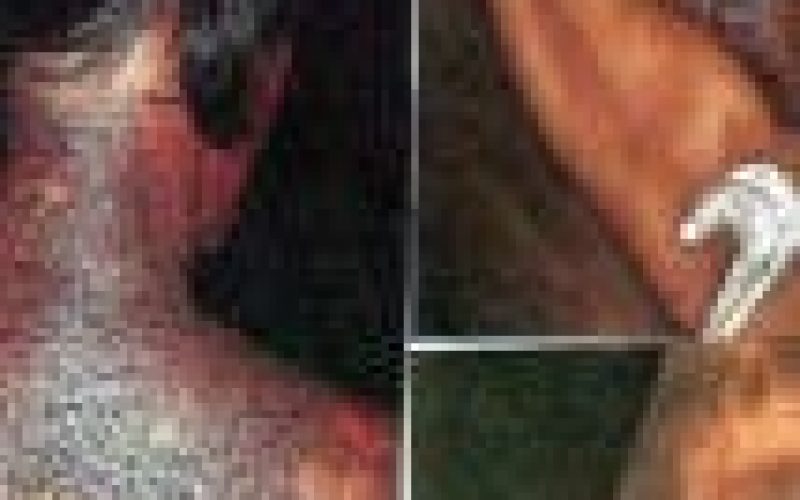 Senate Directive: Dermatologist cautions against skin bleaching