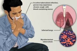 Breaking: TB kills 18 persons per hour in Nigeria – Report