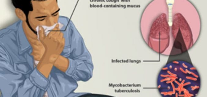 Breaking: TB kills 18 persons per hour in Nigeria – Report