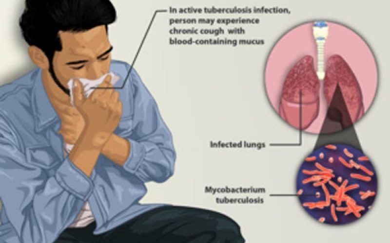 Breaking: TB kills 18 persons per hour in Nigeria – Report