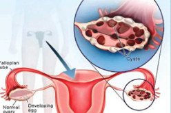 Ovary Syndrom: No one wants to marry a ‘diseased’ woman!
