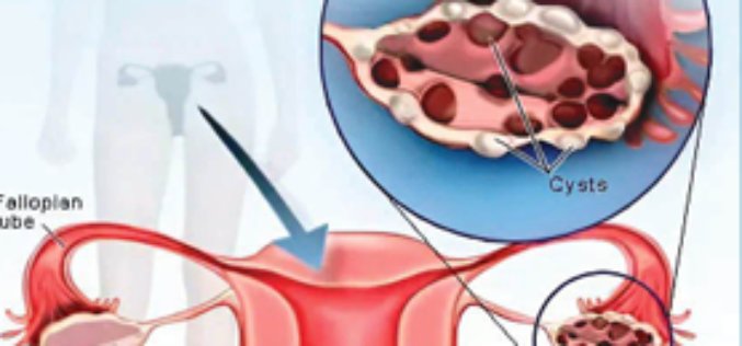 Ovary Syndrom: No one wants to marry a ‘diseased’ woman!