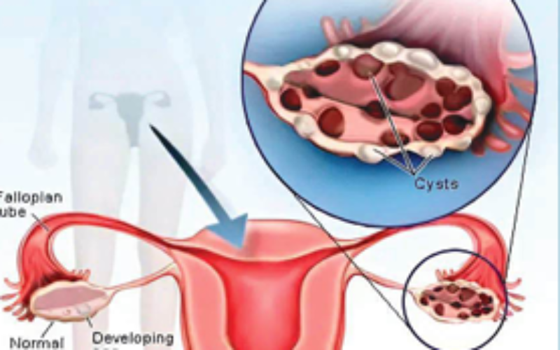 Ovary Syndrom: No one wants to marry a ‘diseased’ woman!