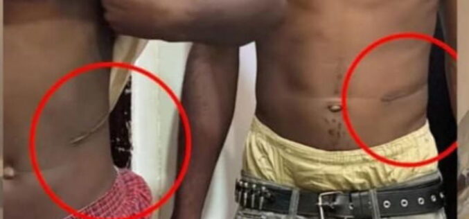 N1.5m for kidney: Lawyer alleges illegal organ harvest in Abuja