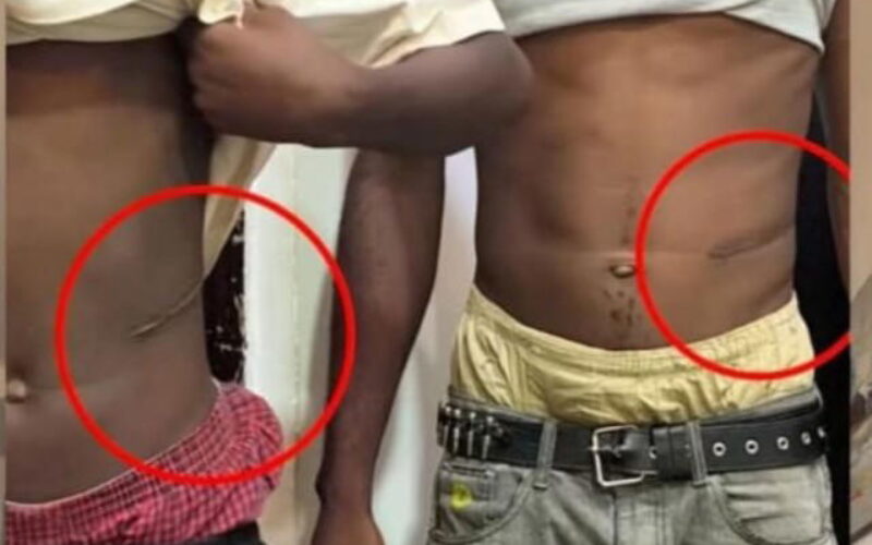 N1.5m for kidney: Lawyer alleges illegal organ harvest in Abuja