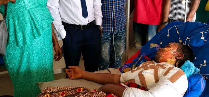 Hot water attack: University student hospitalised with severe burns in Benue