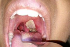 Diphtheria: Abuja barber’s ‘surgery’ made child bleed to death