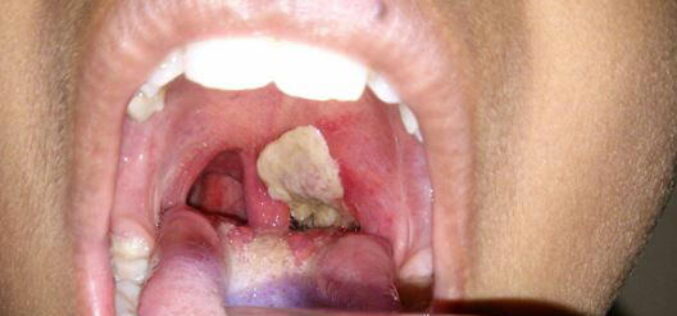 Diphtheria: Abuja barber’s ‘surgery’ made child bleed to death