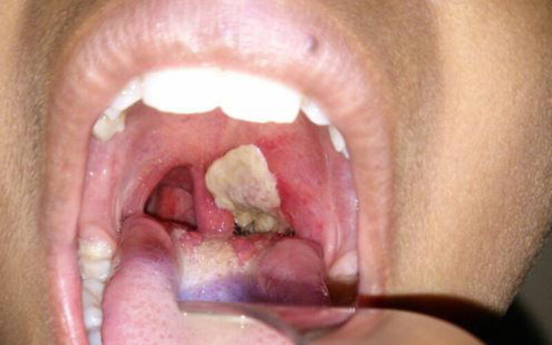 Diphtheria: Abuja barber’s ‘surgery’ made child bleed to death