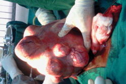 Fibroid without the knife: How sound waves are giving women a new treatment option