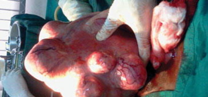 Fibroid without the knife: How sound waves are giving women a new treatment option